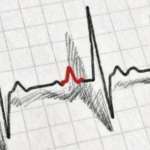 スケッチ風の心電図波形画像。P波部分のみ赤色で、他の波形は黒色。P波は画像中央やや左寄りにあり、周囲に緑丸で示されていた部分が赤色で強調されている。ラベルや補助線は無いシンプルな構成。